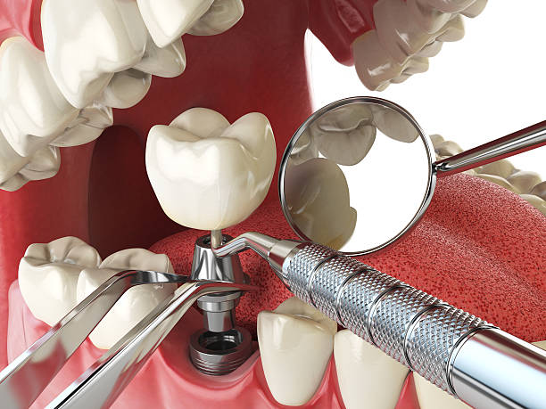 Best Chipped Tooth Repair Near Me  in New Johnsonville, TN